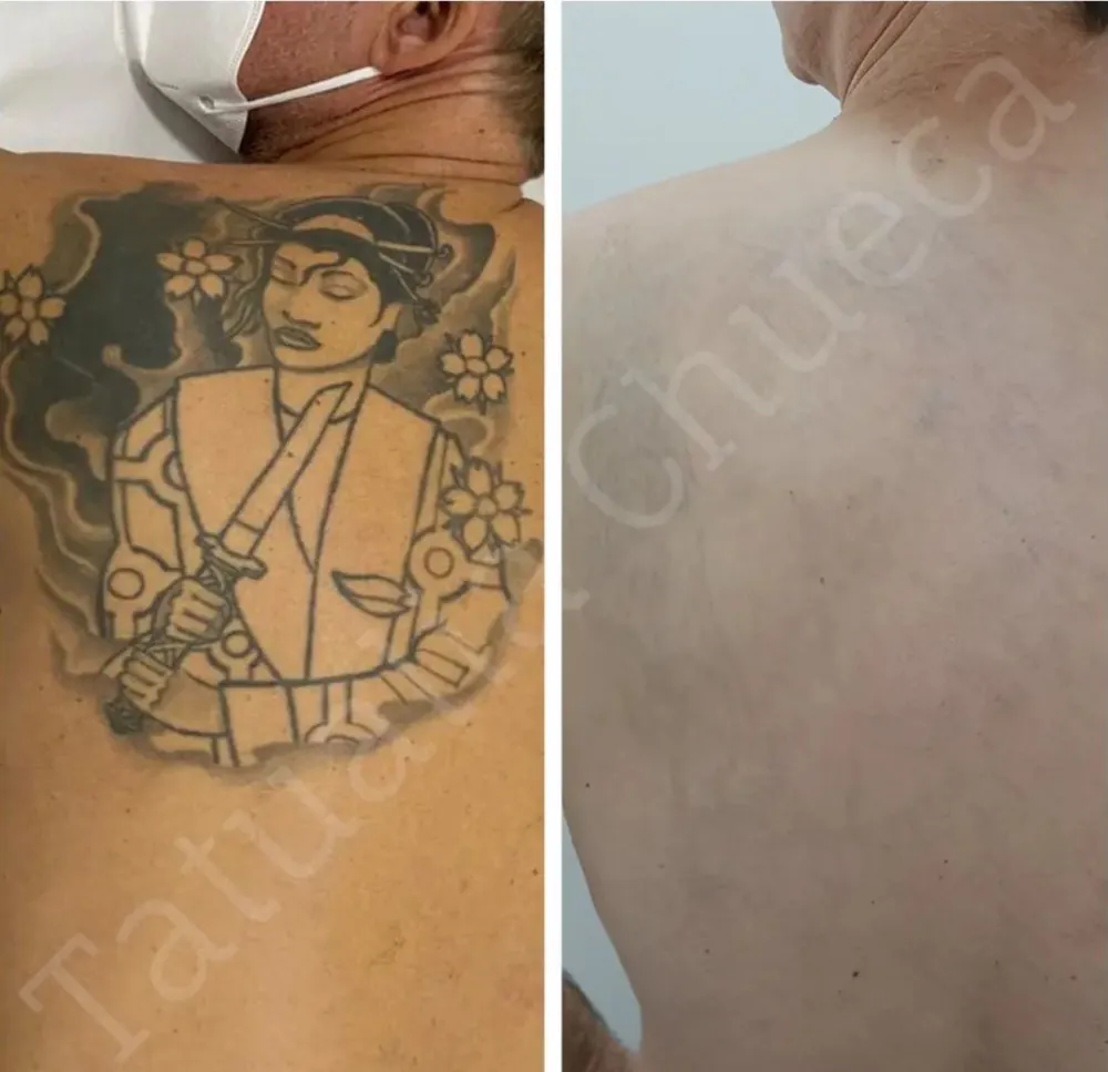 Antes y después de eliminar un tatuaje grande en tinta negra en la espalda