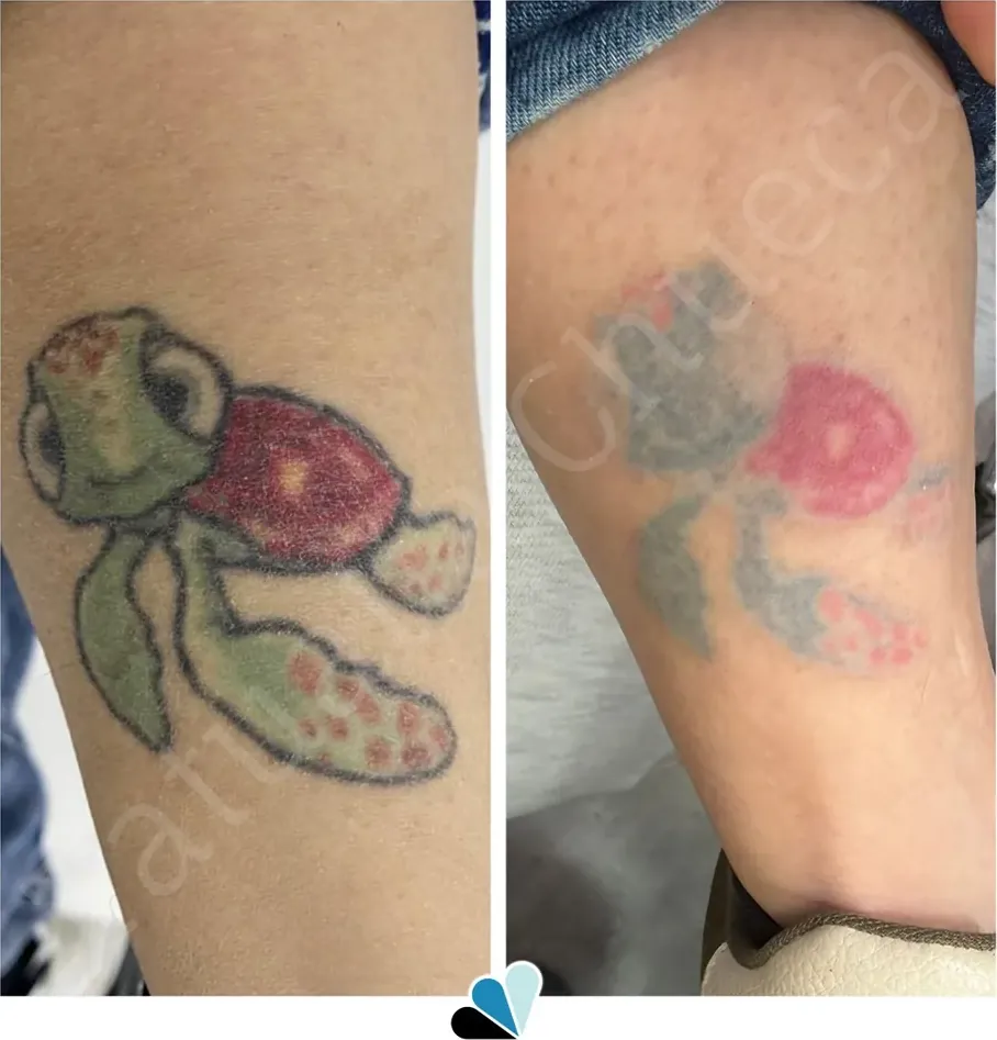 Antes y después de atenuar un tatuaje de tortuga a color