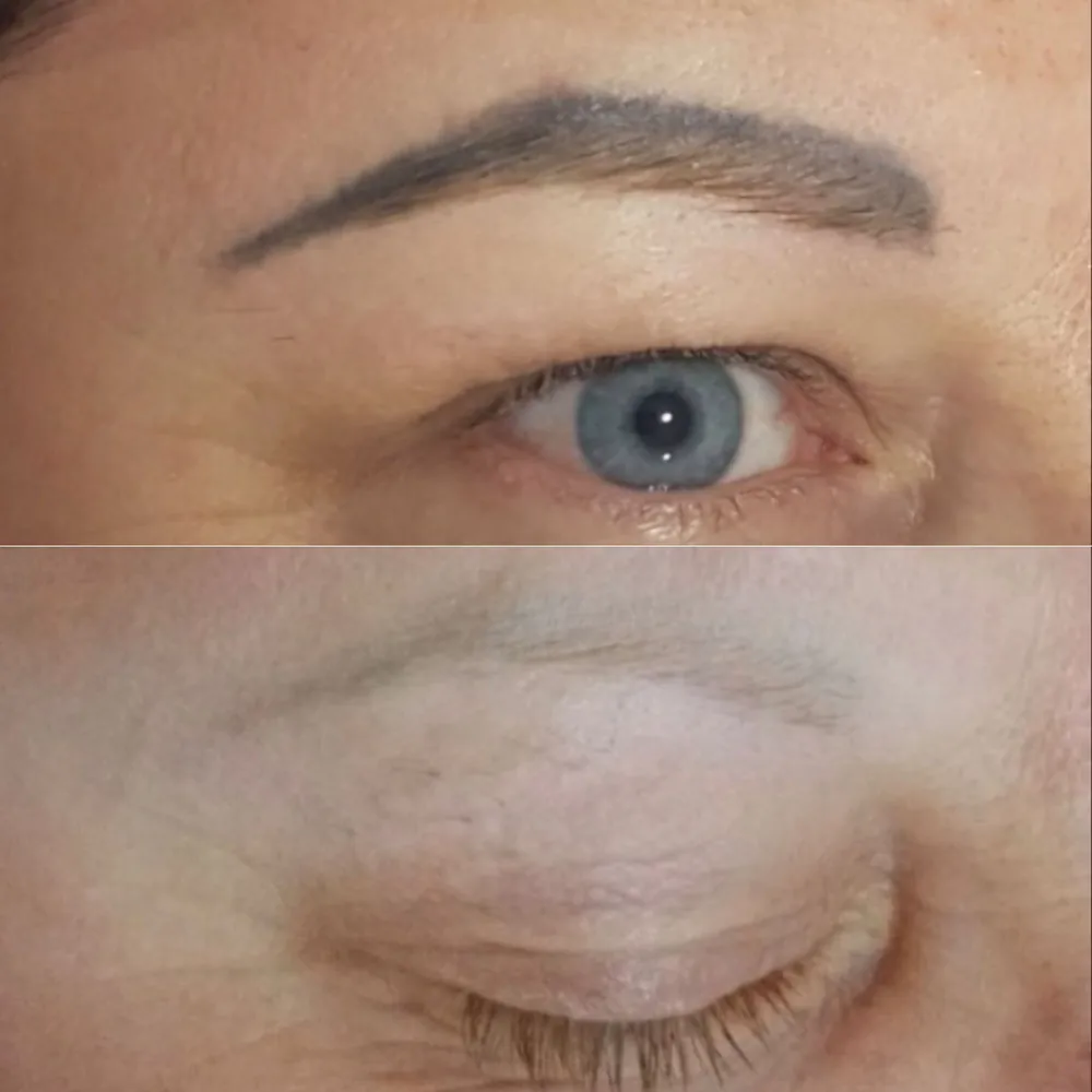 Antes y después de eliminar microblading en la ceja