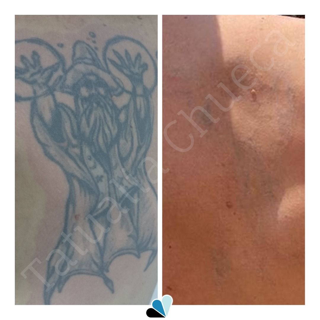 Antes y después eliminación de tatuaje en Tatualia Chueca