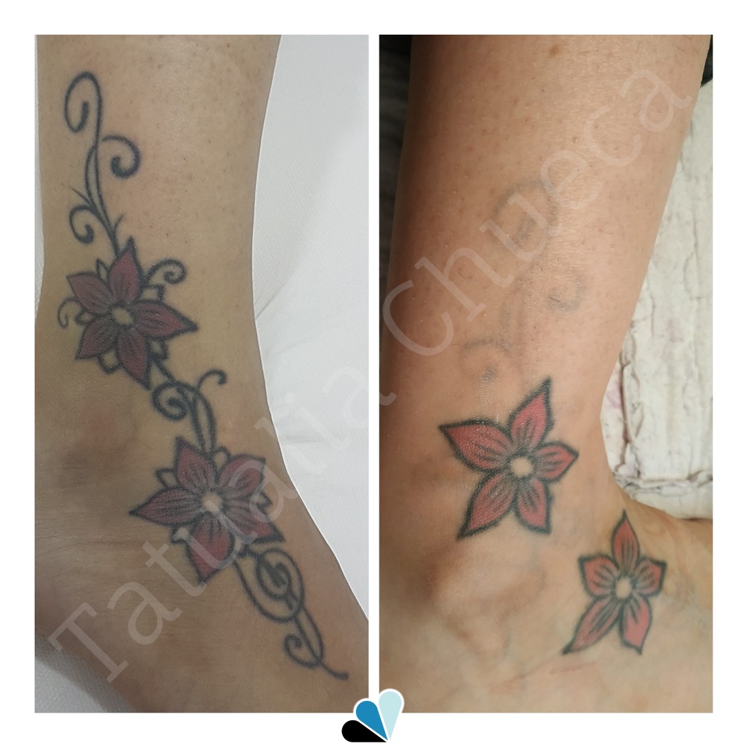 Antes y Después Eliminación tatuaje Tatualia Chueca enredadera