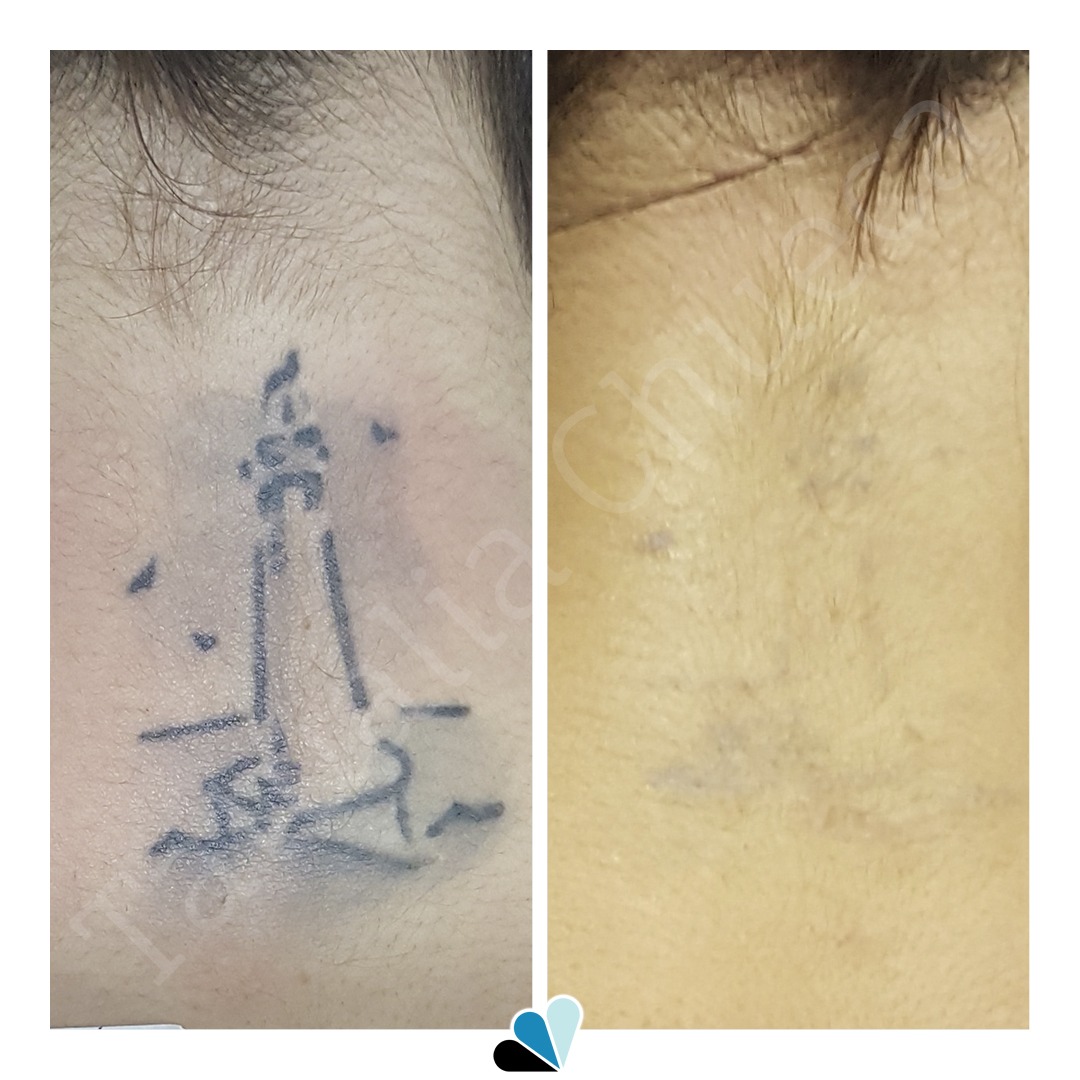 Antes y después eliminación de tatuaje de un Faro en Tatualia Chueca