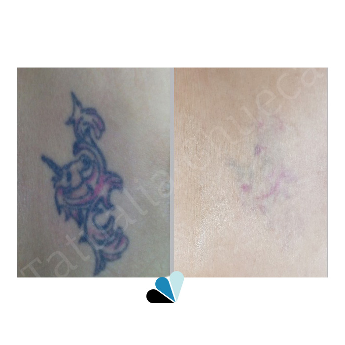 Antes y Después Eliminación de tatuajes Tatualia Chueca Unicornio Lumbar Rosa