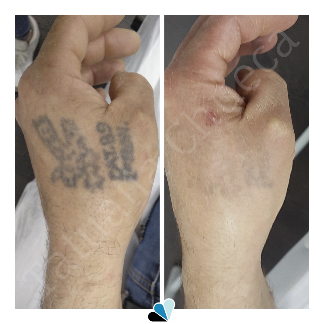 Antes y después eliminación de tatuaje en Tatualia Chueca