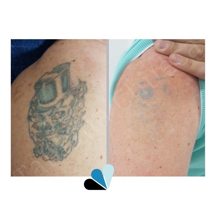Antes y después eliminación de tatuaje en Tatualia Chueca Calavera Taxista