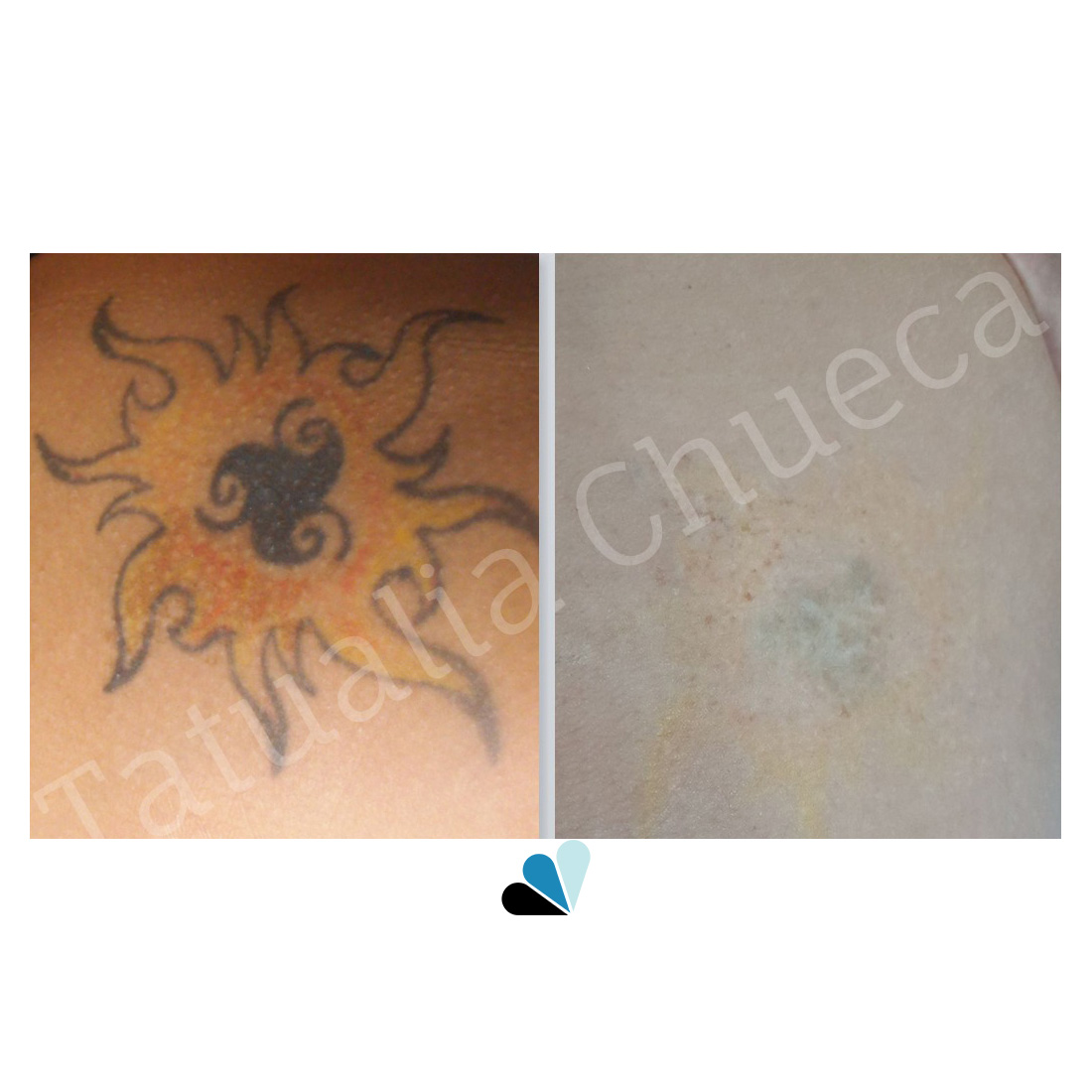 Antes y Después Eliminación de tatuajes Tatualia Chueca Tribal Amarillo