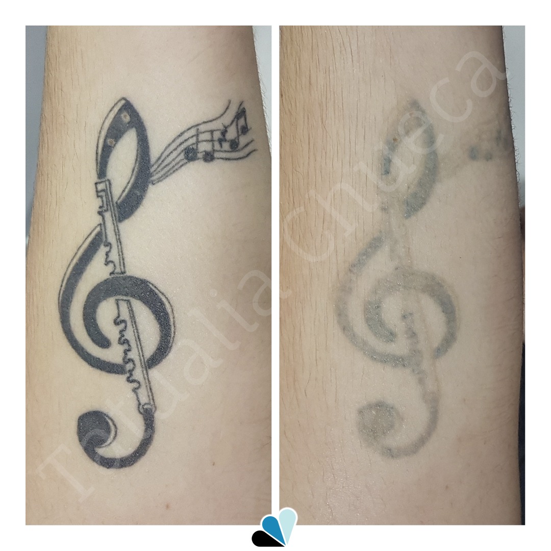 Antes y después eliminación de tatuaje en Tatualia Chueca de una nota musical