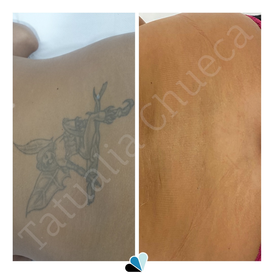 Antes y después eliminación de tatuaje en Tatualia Chueca de un hada