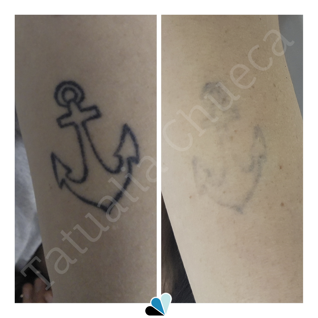 Antes y después eliminación de tatuaje negro de un ancla en Tatualia Chueca