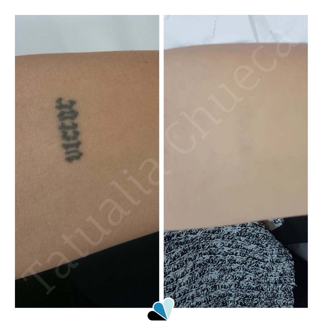 Antes y después eliminación de tatuaje pequeño en Tatualia Chueca