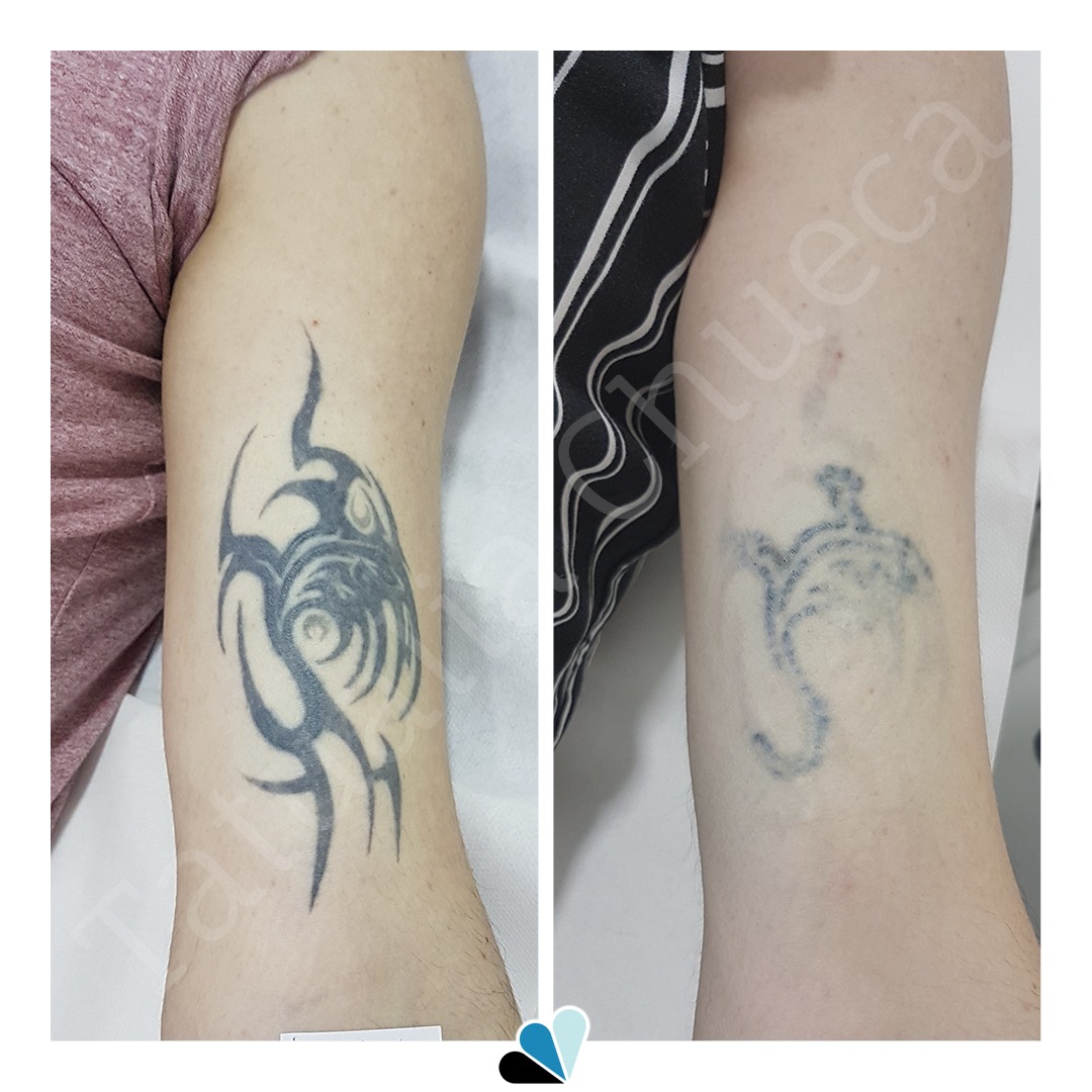 Antes y después eliminación de tatuaje negro en Tatualia Chueca