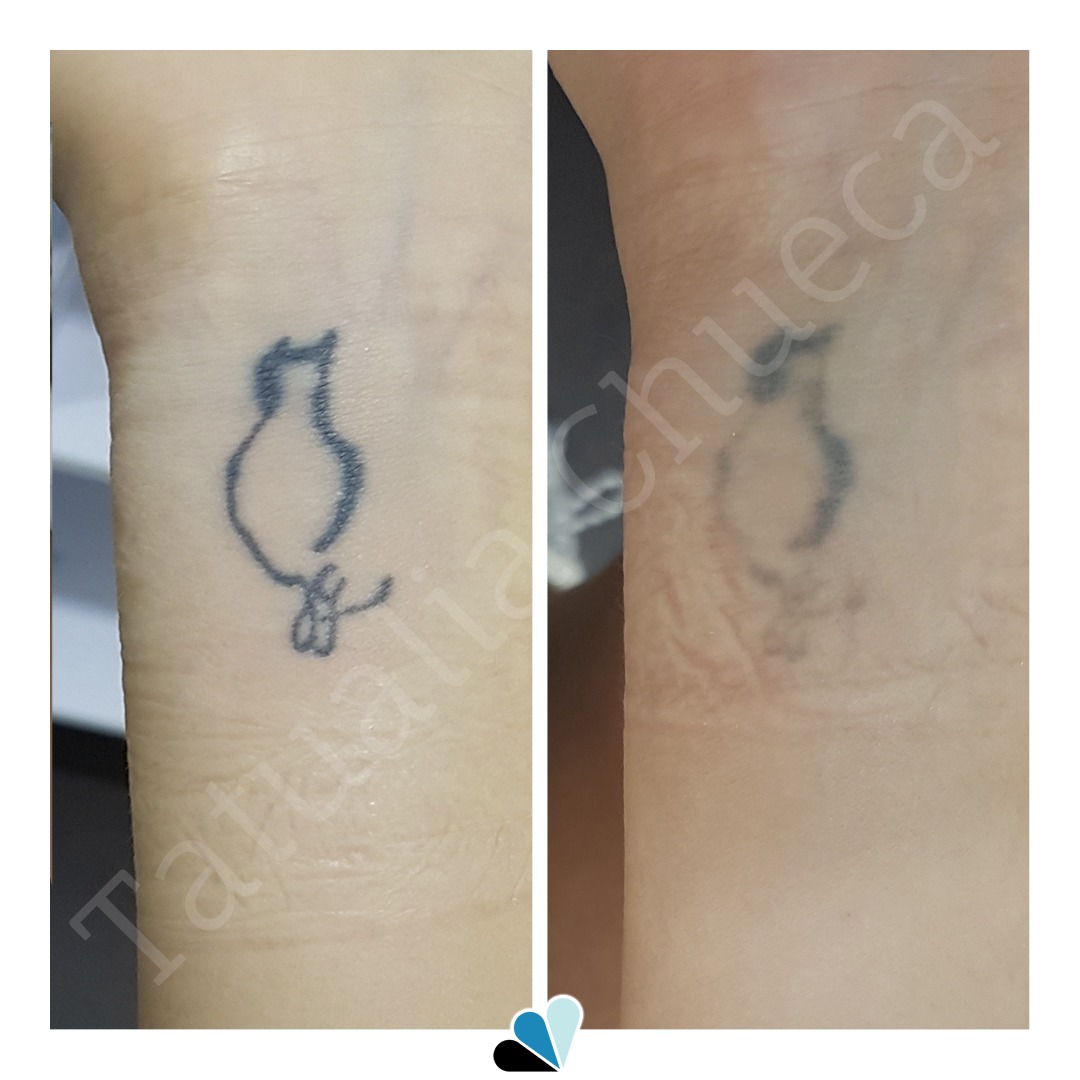 Antes y después eliminación de tatuaje negro de la silueta de un gato en Tatualia Chueca