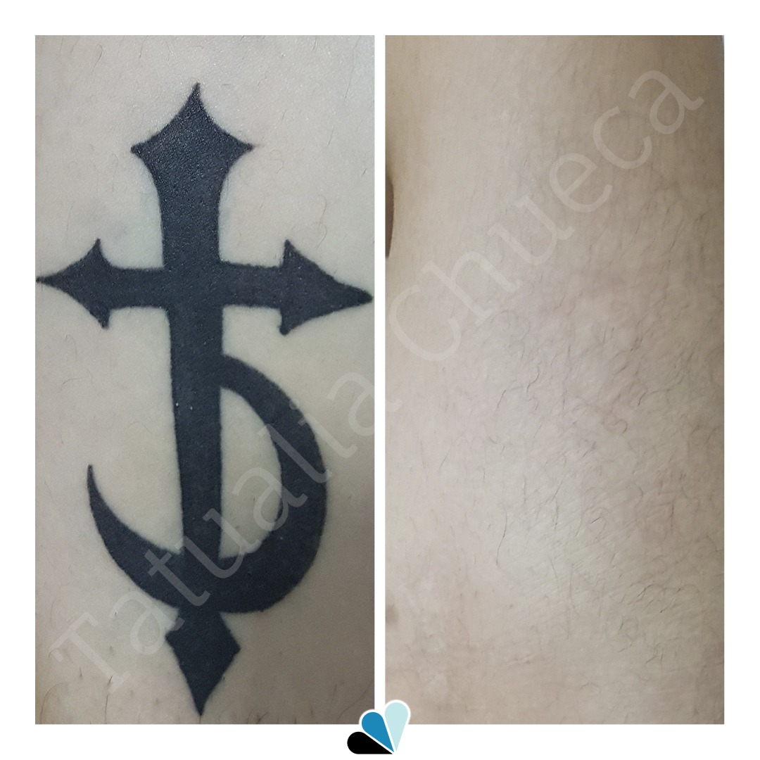Antes y después eliminación de tatuaje negro en Tatualia Chueca