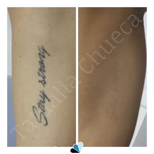 Antes y después eliminación de tatuaje negro en Tatualia Chueca Stay Strong