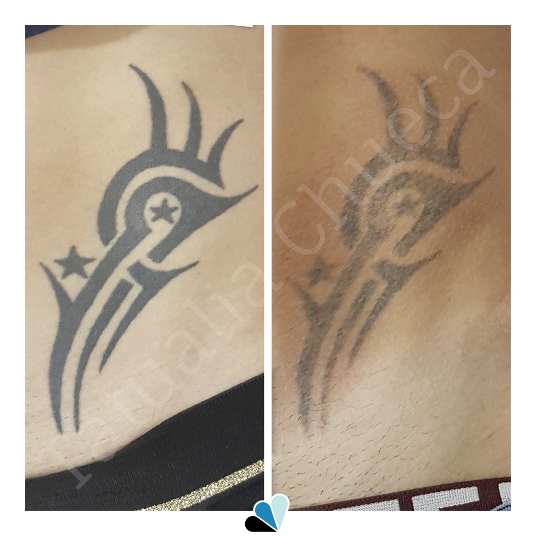 Antes y después eliminación de tatuaje en Tatualia Chueca de un tribal